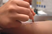 Dị ứng penicillin