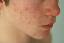 Lý do nam giới dậy thì dễ bị mụn