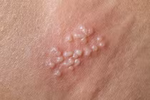 Điều trị mụn rộp sinh dục do nhiễm herpes