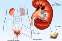 Uống thuốc không thể làm tan sỏi tiết niệu
