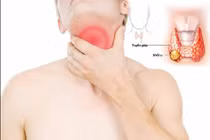 Ung thư tuyến giáp thể không biệt hóa 