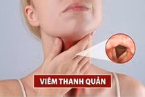 Đâu là cách đối phó với viêm thanh quản cấp ở người lớn an toàn nhất hiện nay?