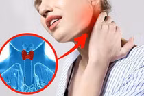 5 triệu chứng bệnh cường giáp bạn không thể bỏ qua
