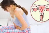 Tầm soát sớm ung thư cổ tử cung