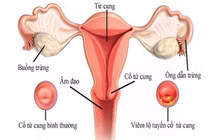  Lộ tuyến cổ tử cung có gây vô sinh?