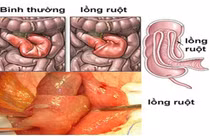 Lồng ruột lại tưởng kiết lỵ