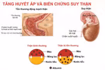 Tăng huyết áp ở người suy thận mạn