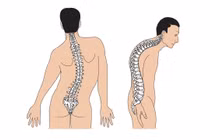 Vẹo cột sống không nên bi quan