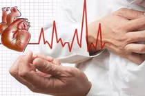  Nhồi máu cơ tim vì hội chứng động mạch vành cấp