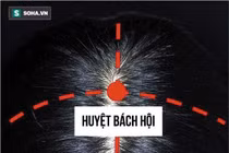 Day huyệt bách hội chữa huyết áp thấp, rối loạn tiền đình