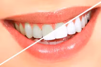 Thực phẩm rẻ tiền làm trắng răng