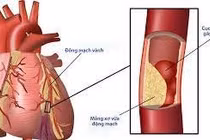 Tổn thương mạch vành ở bệnh nhân đái tháo đường