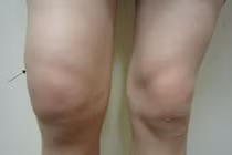 Tràn dịch khớp gối