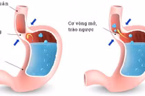 Dấu hiệu của bệnh trào ngược dạ dày thực quản