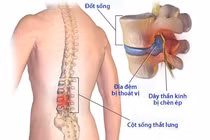 Chẩn đoán và phòng ngừa thoát vị đĩa đệm