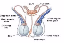 Giãn tĩnh mạch thừng có thể gây vô sinh