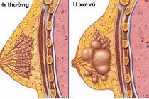15 tuổi đã phải mổ u xơ tuyến vú