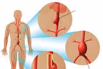 Bóc tách động mạch chủ có thể gây nhồi máu cơ tim
