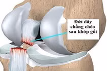 Tổn thương dây chằng chéo sau có phải mổ?