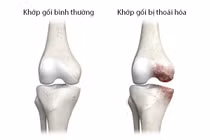 Làm gì để cải thiện thoái hóa khớp?
