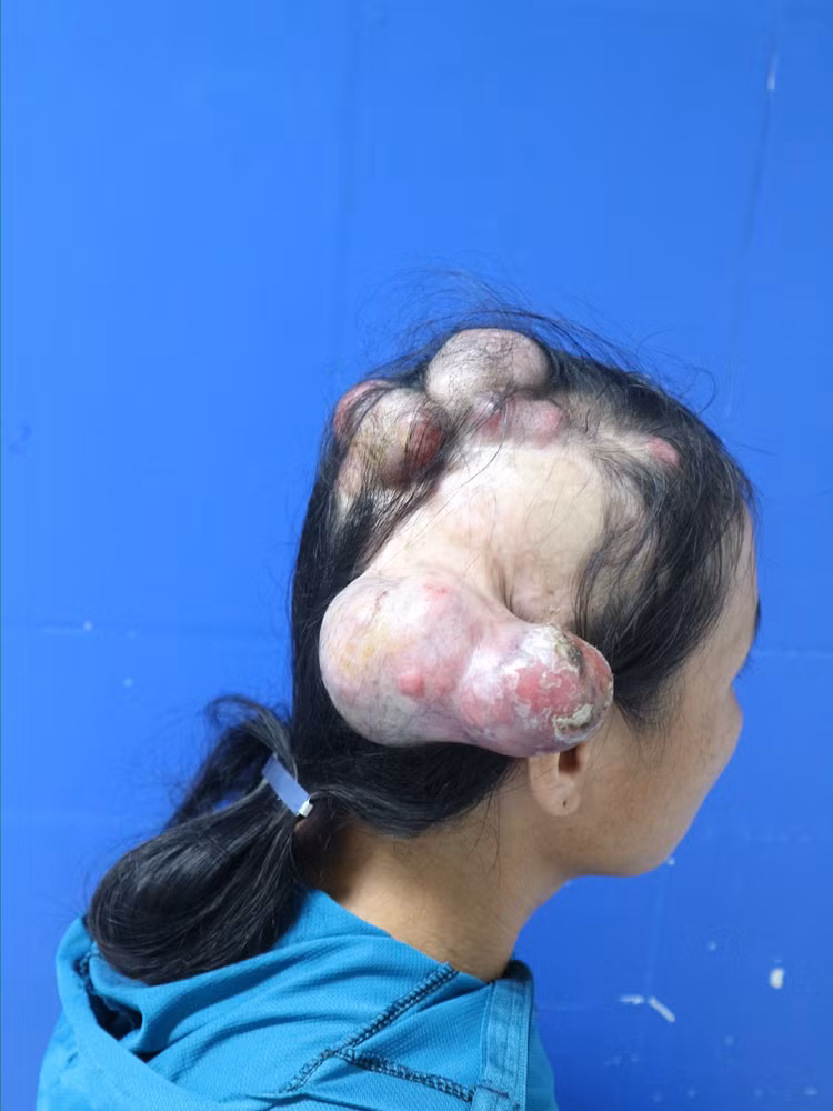 Căn bệnh khiến người phụ nữ "mọc sừng" kỳ lạ trên đầu Can benh khien nguoi phu nu