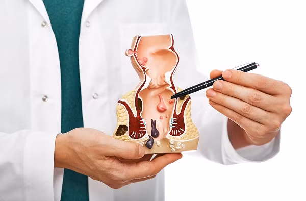Bệnh trĩ gây biến chứng nguy hiểm: Phòng ngừa thế nào? Ảnh minh họa: ID.