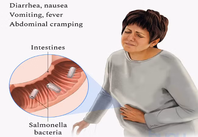 Triệu chứng nhiễm khuẩn Salmonella dễ nhầm lẫn - Hình 2 Ảnh: BH.