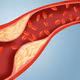 Chế độ ăn giảm cholesterol xấu, phòng ngừa bệnh tim mạch
