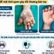 Bệnh nhân bỏng sâu bàn tay do điện thoại nổ khi sạc