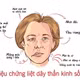 Liệt dây thần kinh số 7: Nhận biết sớm để tránh biến chứng nặng