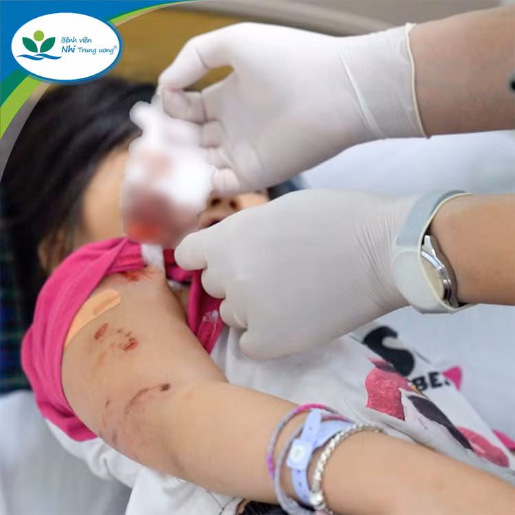 Bé H.A được sơ cấp cứu kịp thời và chuyển đến Bệnh viện Nhi Trung ương - Ảnh: BVCC Bé H.A được sơ cấp cứu kịp thời và chuyển đến Bệnh viện Nhi Trung ương - Ảnh: BVCC