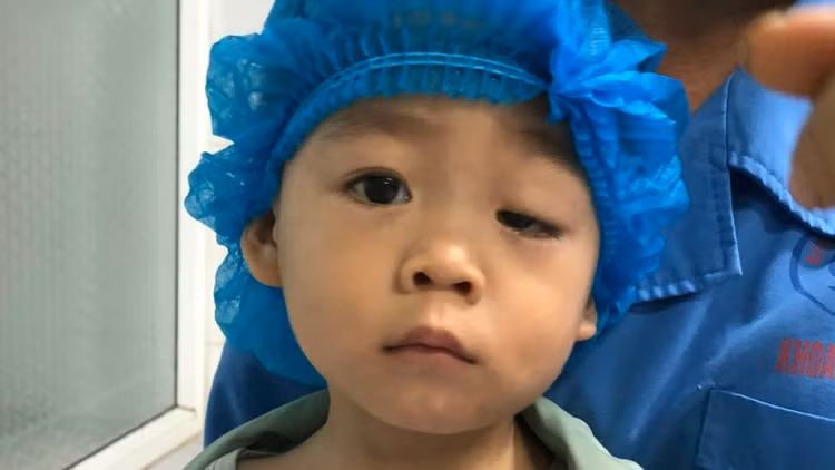 Hình ảnh bé D.B.A trước khi phẫu thuật sụp mi - Ảnh BVCC Hình ảnh bé D.B.A trước khi phẫu thuật sụp mi - Ảnh BVCC