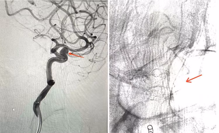 Mạch máu não trước &amp; sau can thiệp. Sau khi đặt stent nở tốt, đúng vị trí - Ảnh BVCC
