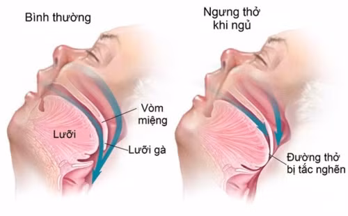 Biểu hiện ngưng thở khi ngủ - Ảnh BSCC Biểu hiện ngưng thở khi ngủ - Ảnh BSCC