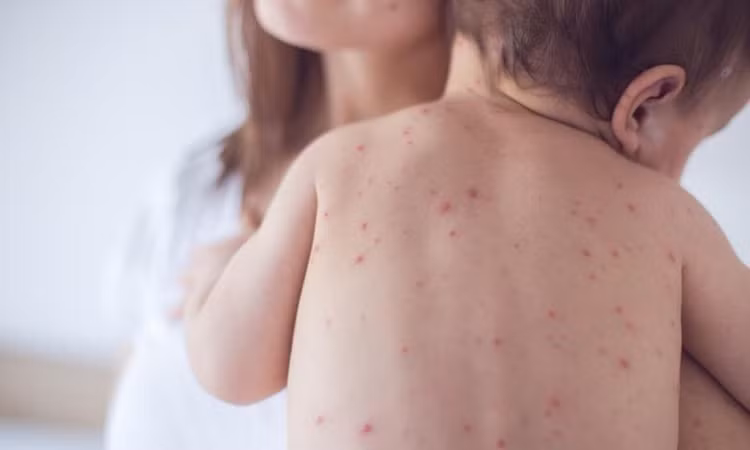Hà Nội: Tăng cường giám sát bệnh Sởi - Ảnh minh họa