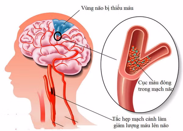 Dấu hiệu của thiếu máu não đừng chủ quan đột quỵ như chơi