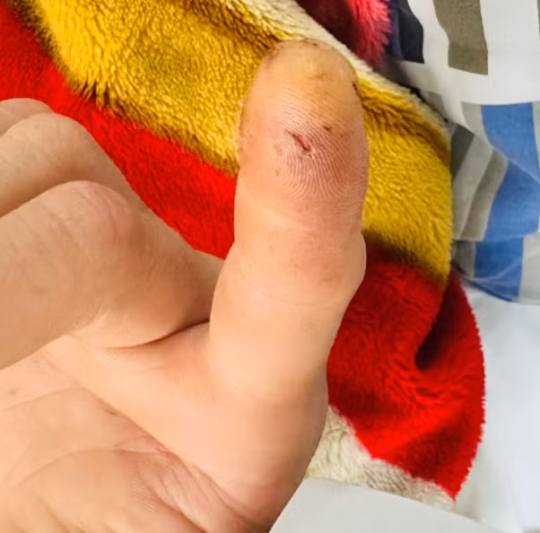 Bệnh nhân bị Cu li cắn vào đầu ngón tay - Ảnh BVCC Bệnh nhân bị Cu li cắn vào đầu ngón tay - Ảnh BVCC