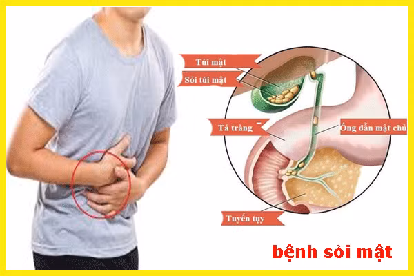 Bác sĩ chỉ thói quen tưởng vô hại nhưng dễ gây sỏi mật, polyp mật