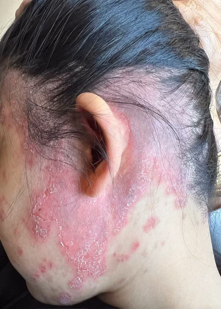 Tổn thương đa cơ quan vì Lupus ban đỏ ảnh 1 Tổn thương đa cơ quan vì Lupus ban đỏ ảnh 1