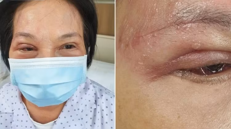 Bà Như, 55 tuổi, bị zona thần kinh tấn công vào mắt - Ảnh BVCC