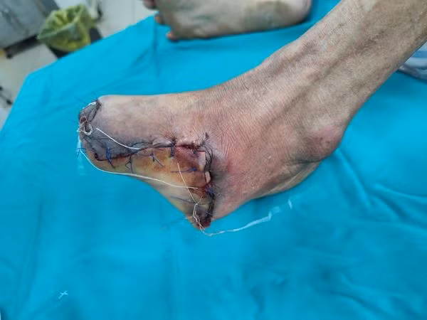 Quấn thuốc đông y trị tê chân, bệnh nhân phải cắt bàn chân vì bỏng ảnh 1 Quấn thuốc đông y trị tê chân, bệnh nhân phải cắt bàn chân vì bỏng ảnh 1