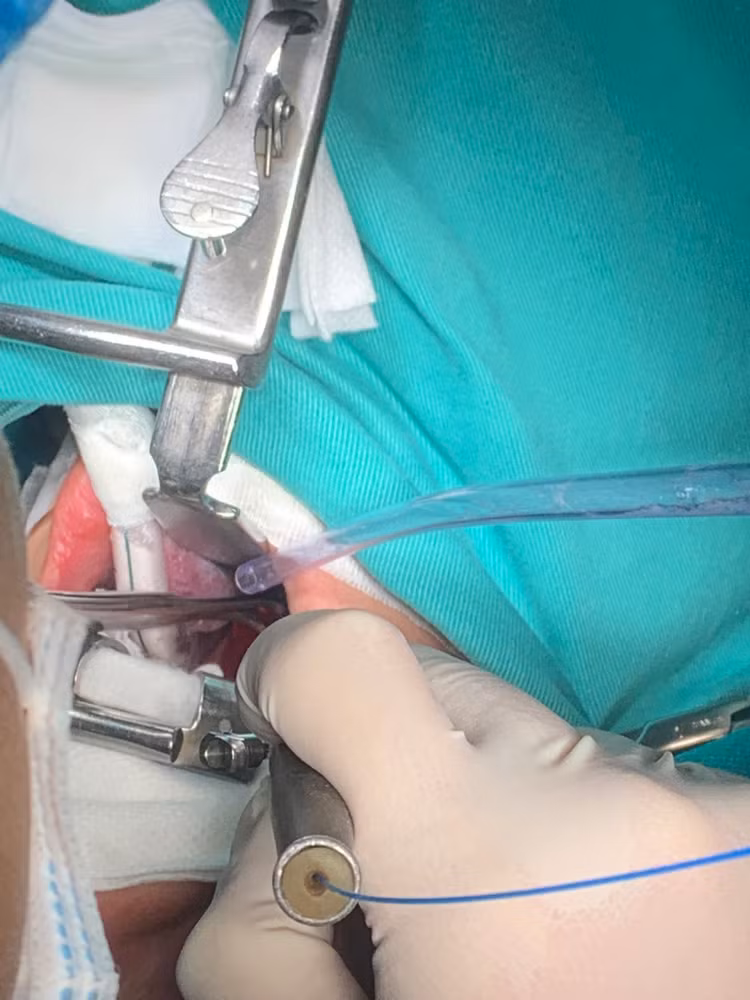 Cắt Amidan bằng Laser - Công nghệ mới nhẹ nhàng, êm ái, phục hồi nhanh chóng Cắt Amidan bằng Laser - Công nghệ mới nhẹ nhàng, êm ái, phục hồi nhanh chóng