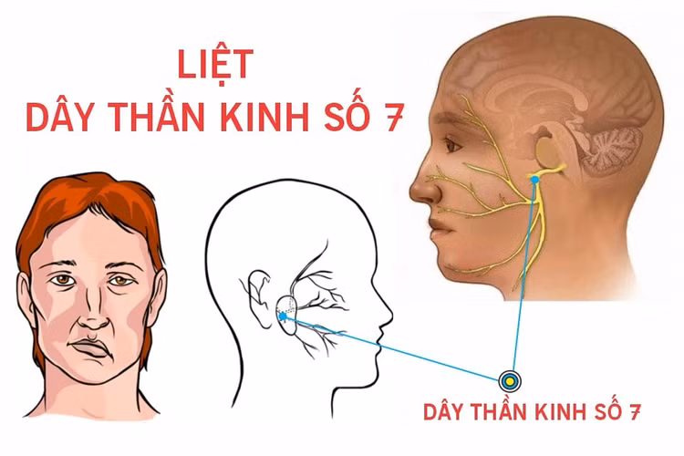 Cách tránh miệng và mắt méo lệch do trời lạnh