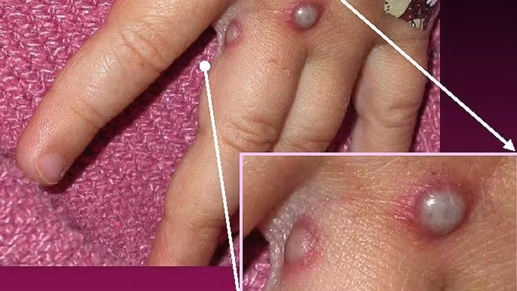 Cách phân biệt bệnh đậu mùa khỉ và tay chân miệng - Ảnh minh họa