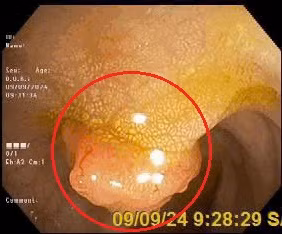 Hình ảnh polyp đại tràng của chị N. (vùng khoanh tròn màu đỏ) - Ảnh BVCC Hình ảnh polyp đại tràng của chị N. (vùng khoanh tròn màu đỏ) - Ảnh BVCC