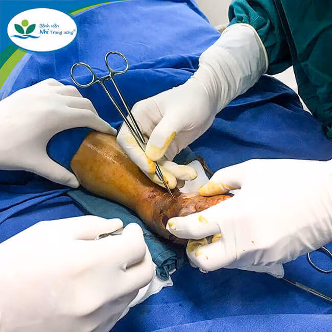 Các bác sĩ Khoa Chỉnh hình tiến hành phẫu thuật mở cân để giải phóng chèn ép khoang tại vị trí chân trái của trẻ. Các bác sĩ Khoa Chỉnh hình tiến hành phẫu thuật mở cân để giải phóng chèn ép khoang tại vị trí chân trái của trẻ.