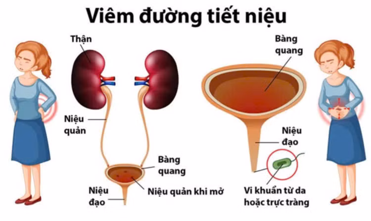 Nhiễm trùng tiết niệu tiền mãn kinh, hiểu để bảo vệ sức khỏe từ gốc - Ảnh BSCC Nhiễm trùng tiết niệu tiền mãn kinh, hiểu để bảo vệ sức khỏe từ gốc - Ảnh BSCC