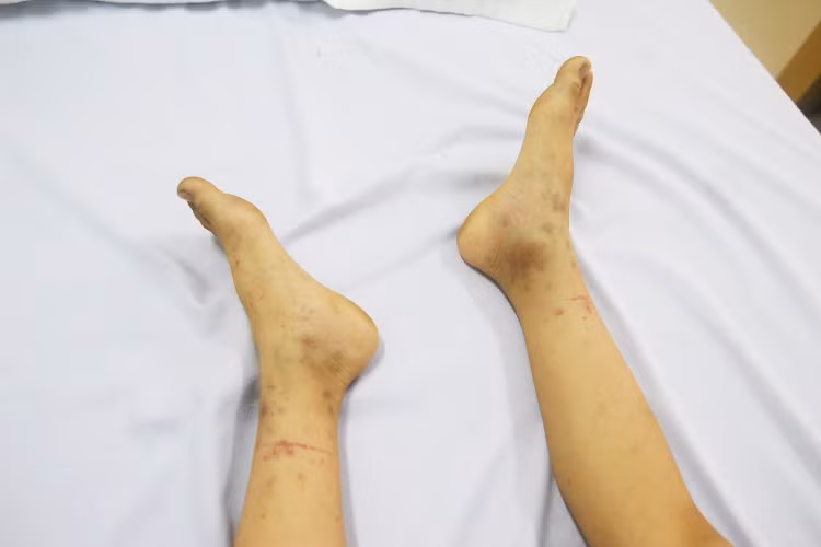 Trẻ bị sưng đau các khớp chủ yếu ở khớp gối và cổ chân