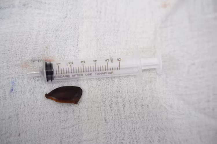 Hạt hồng xiêm được gắp ra - Ảnh BVCC