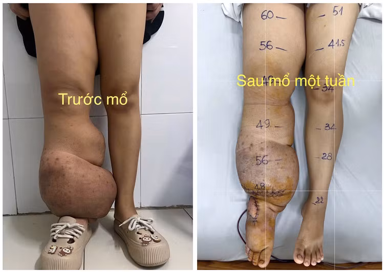 Hình ảnh phù bạch mạch trước và sau mổ - Ảnh BVCC Hình ảnh phù bạch mạch trước và sau mổ - Ảnh BVCC